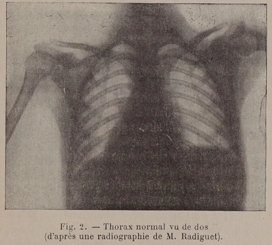 Radiographie ancienne d'un thorax vu de dos, où se lisent les côtes, les clavicules et les omoplates