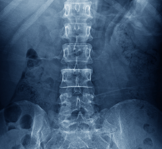 Radiographie colonne vertébrale en noir et blanc