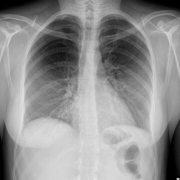 Chest bone age