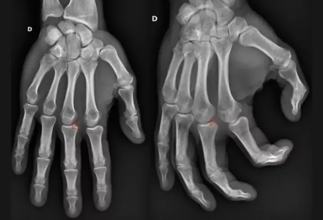 latest news_radiography of the right hand