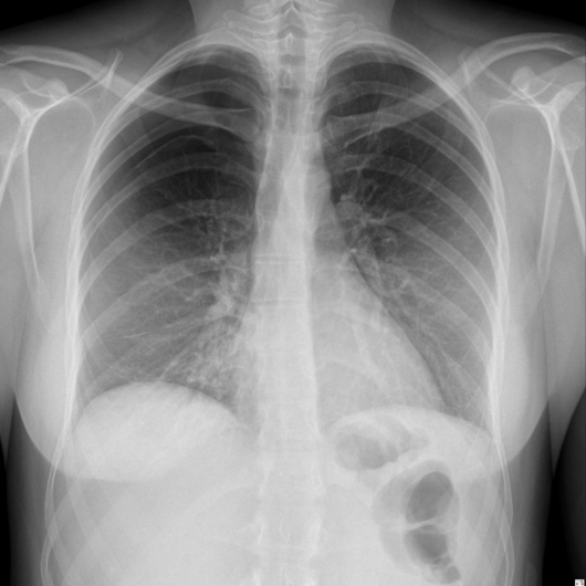 Chest X-ray image. Tech Care Chest