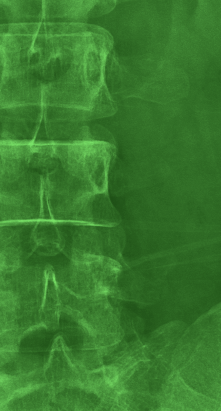 Radiographie en gros plan avec fond vert