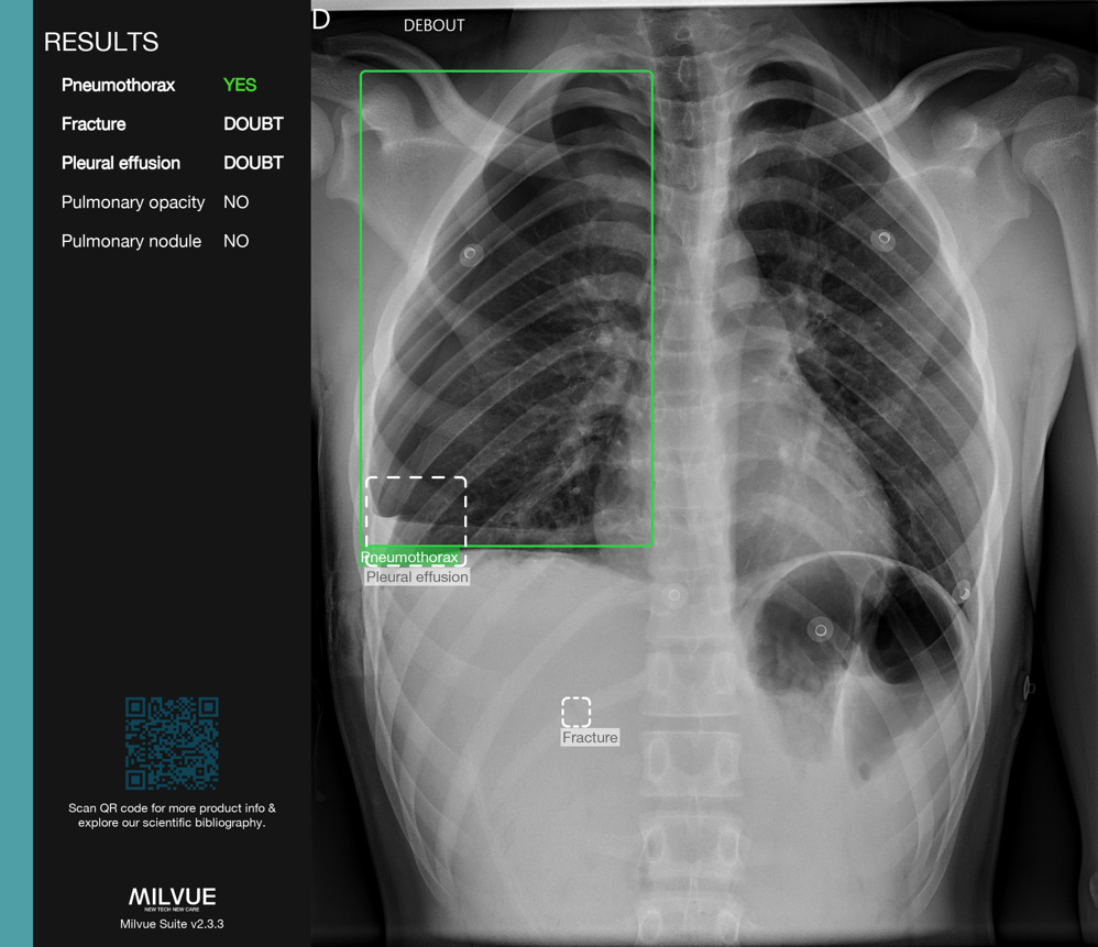 Pneumothorax Pediatric
